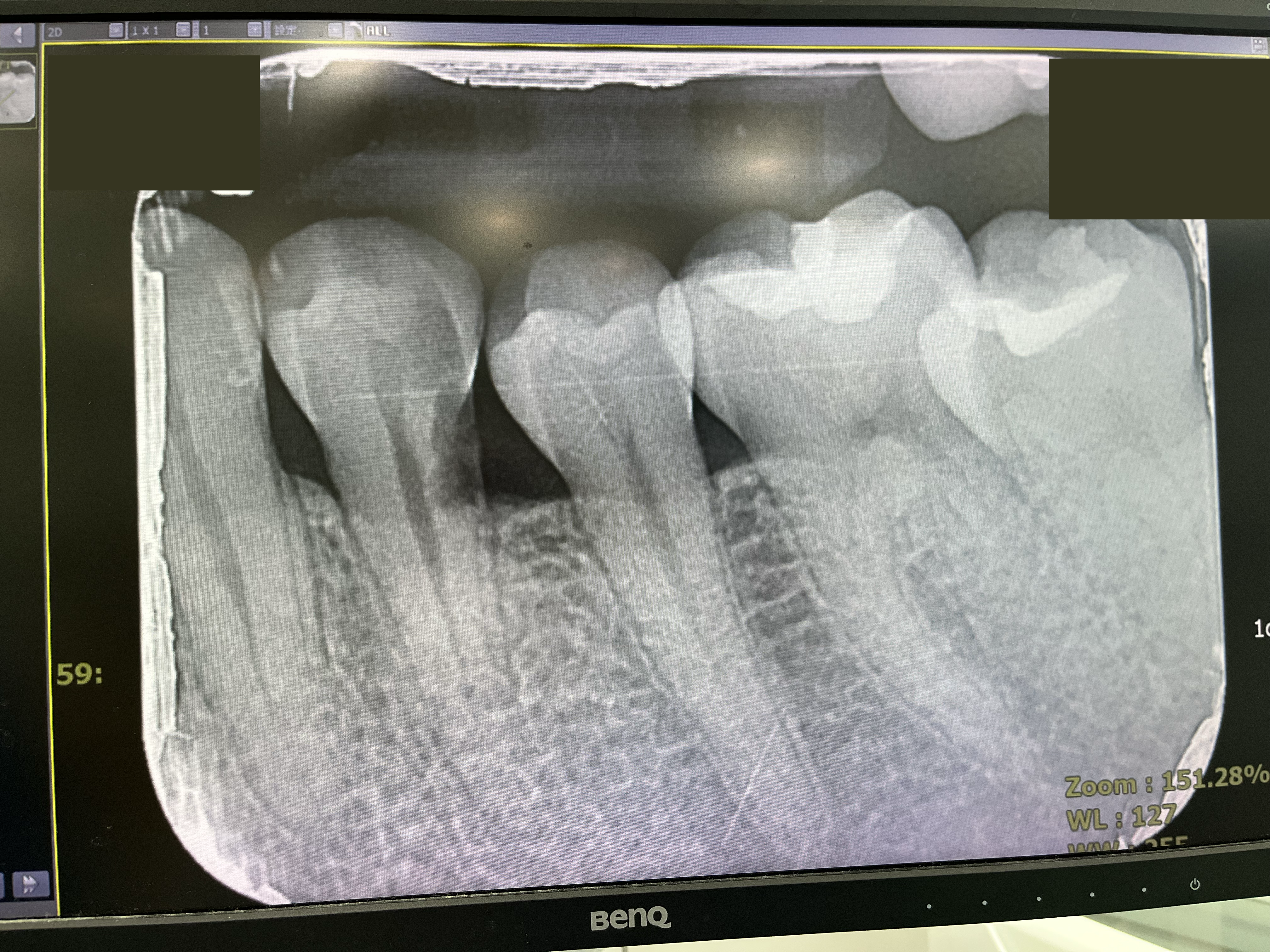 what_happen_to_tooth.webp